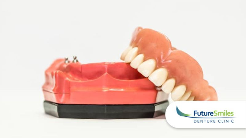 What Are All-On-4 Denture Implants